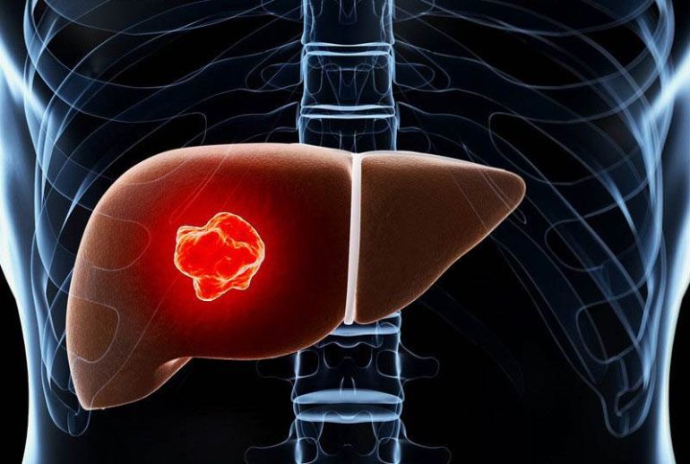 دکتر برداشتن کبد - اصفهان