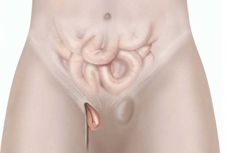 دکتر فتق کشاله ران - رشت