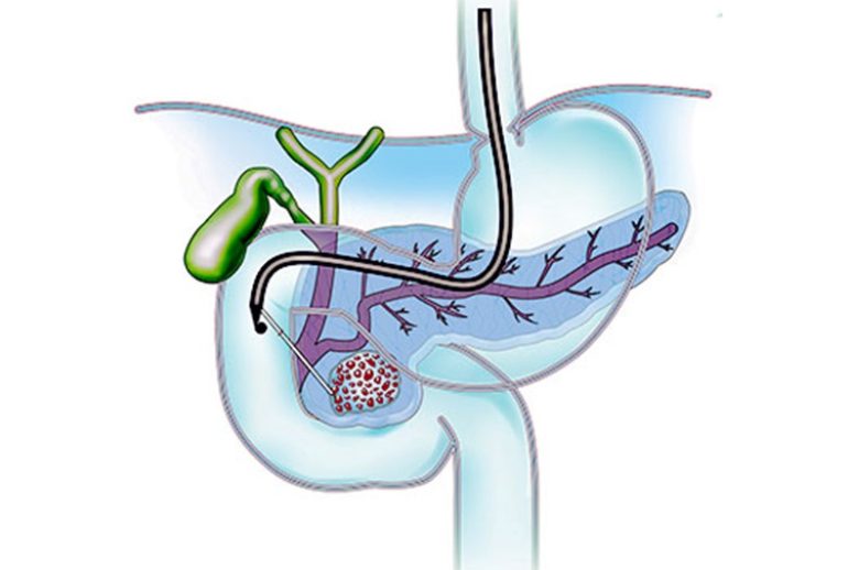 دکتر کیست کاذب پانکراس - تبریز
